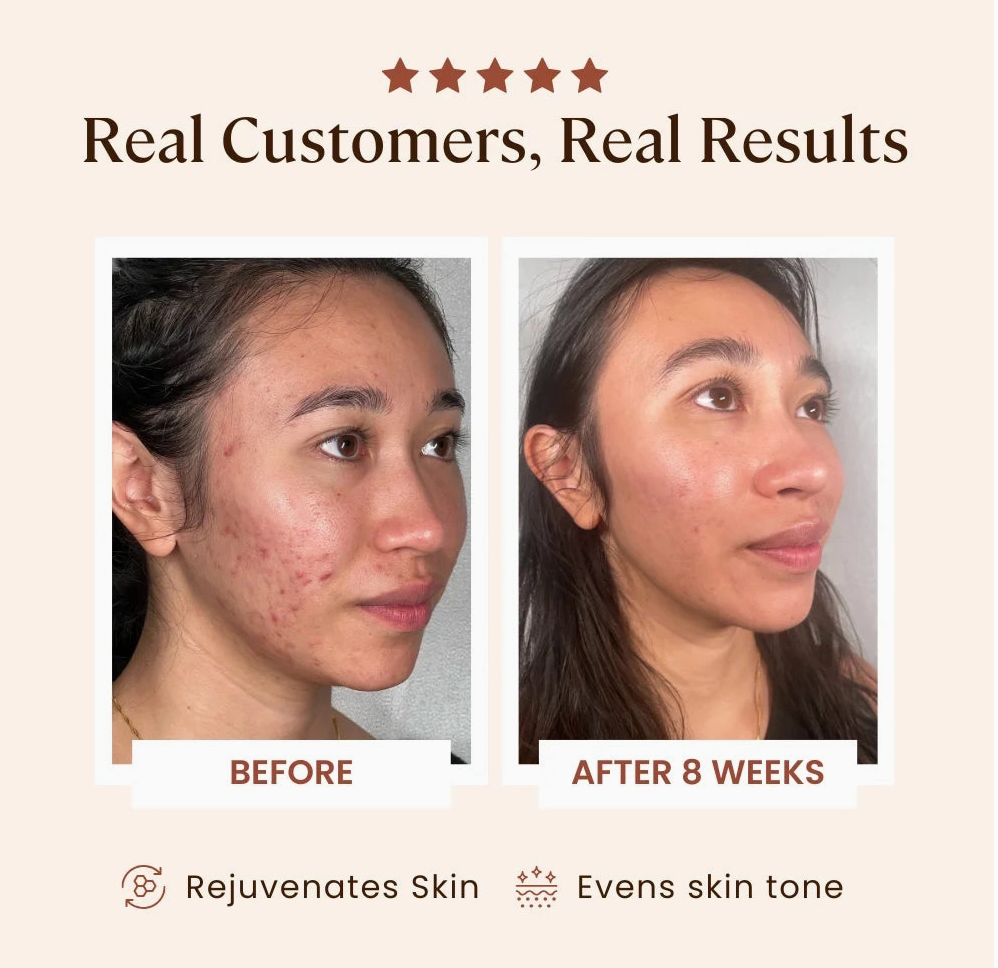 Plasma Skin Perfector
