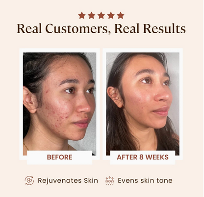 Plasma Skin Perfector